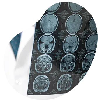 Infiltración de neurotoxina